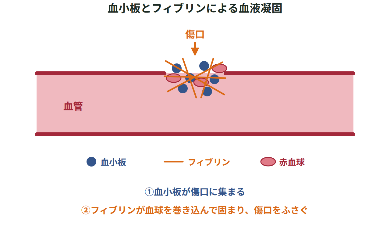 血管の壁が切れた傷口に血小板が集まり、フィブリンが赤血球などの血球を巻き込んで傷口をふさぐ様子を示した図
